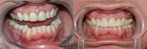 Upper anterior crowns & Invisalign Upper anterior crowns & Invisalign