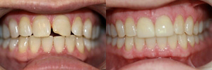 Upper anterior crowns & Invisalign Upper anterior crowns & Invisalign