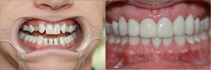 Upper/lower crowns & Invisalign Upper/lower crowns & Invisalign