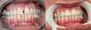 Upper anterior crowns Upper anterior crowns