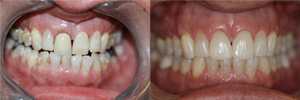 Upper anterior crowns & Invisalign Upper anterior crowns & Invisalign