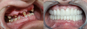 Full Mouth Reconstruction- crowns and bridges Full Mouth Reconstruction- crowns and bridges