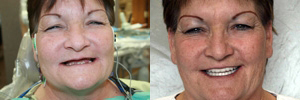 Full Mouth Reconstruction- crowns and bridges Full Mouth Reconstruction- crowns and bridges