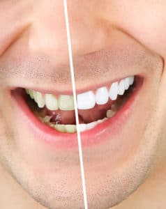 teeth whitening 2 238x300 1