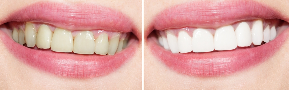 Whitening Before and After Patient Mesa AZ | Gilbert | Tempe