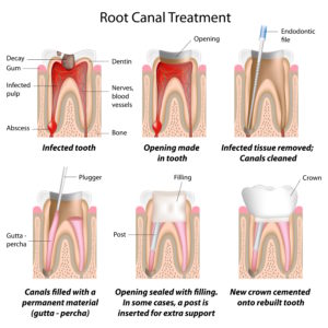 Root Canal Treatment | Drs of Smiles | Mesa | Phoenix AZ