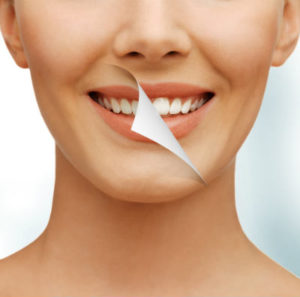 The Truth About Teeth Whitening