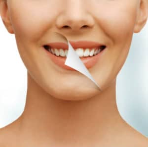 teeth whitening 300x297 1