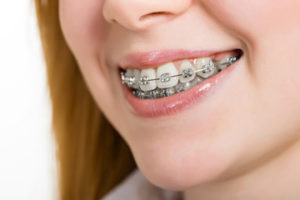 6 Steps for Brushing With Braces