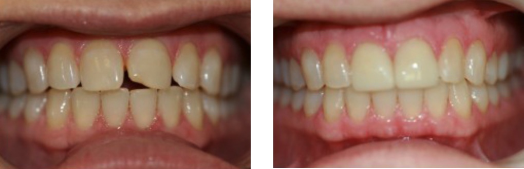 Before and After Veneers | Drs of Smiles | Mesa, AZ