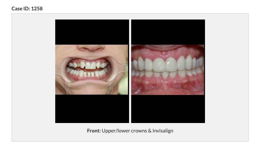 before and after upper/lower crowns and Invisalign