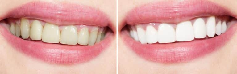 teeth whitening before and after