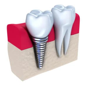 cross section of single tooth dental implant screwed in gum