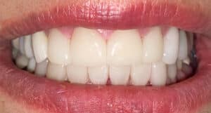 Crowns & Veneers