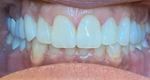 Crowns & Veneers