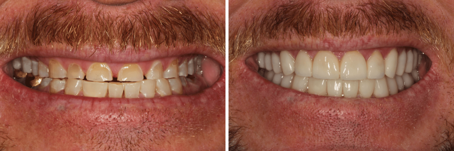 Before and After Full Mouth ReconstructionSmile Makeover