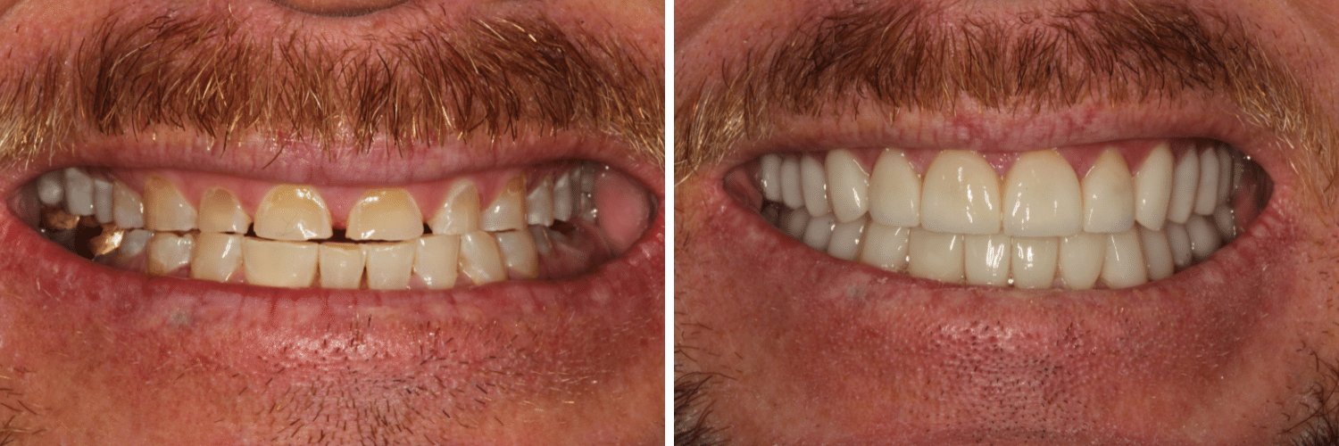 patient’s smile before and after makeover and full mouth reconstruction, teeth fuller and whiter after procedure