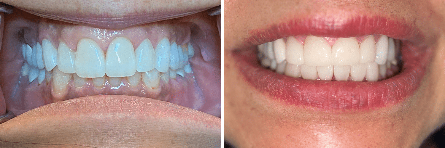 Veneers + Crowns