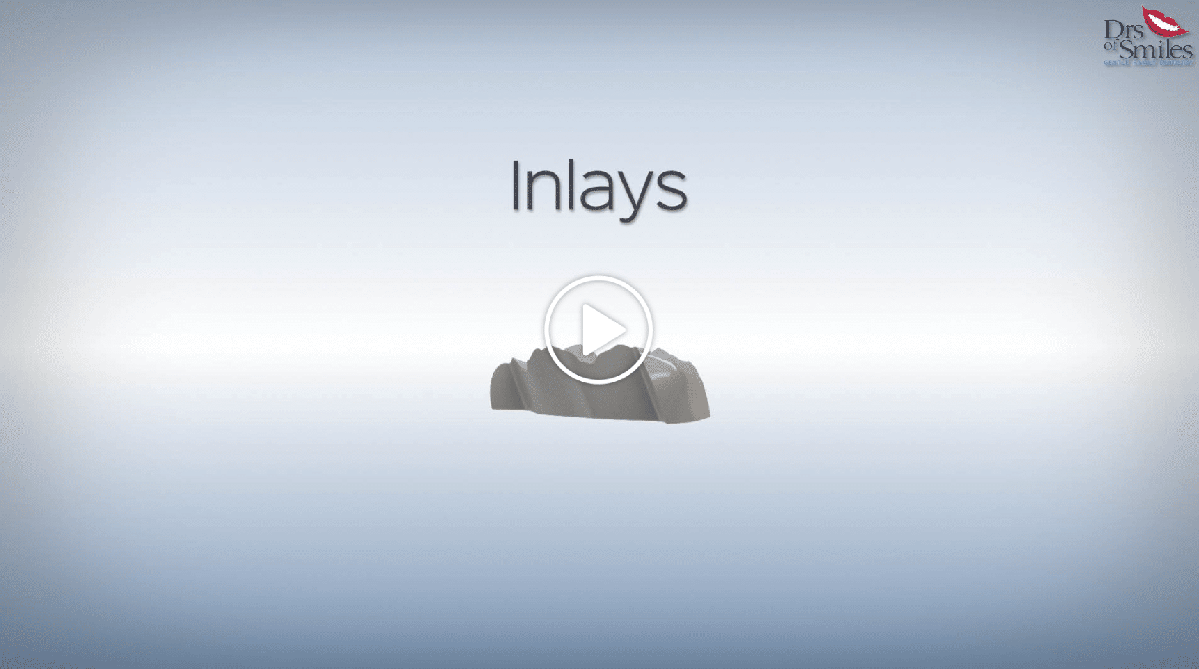 inlays