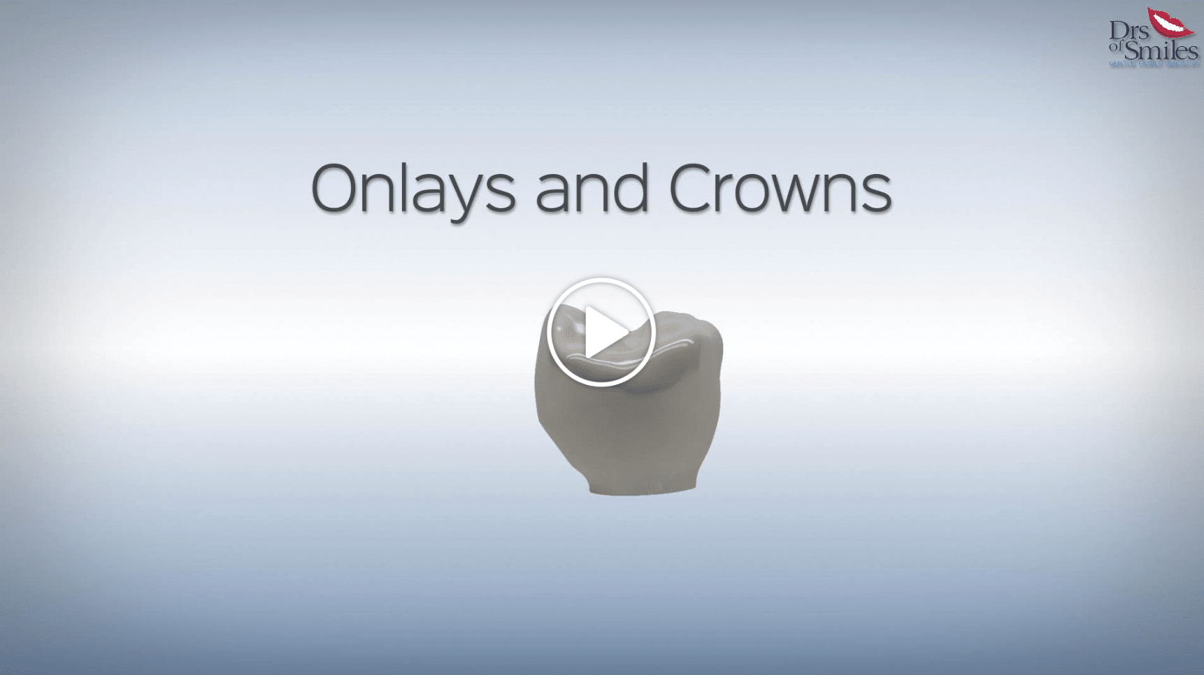 onlays