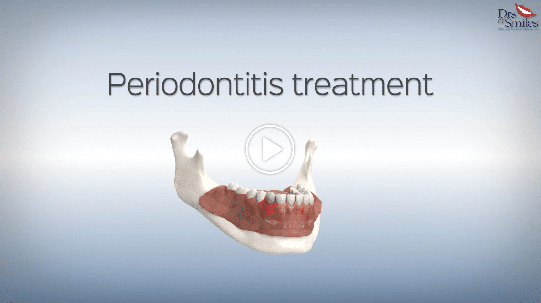 periodonitis treatment