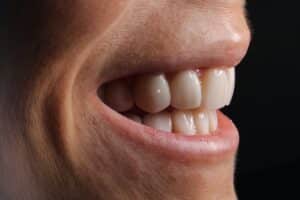 porcelain veneers