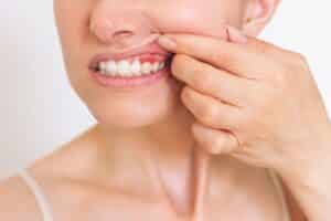 Close-up of a woman lifting her lip to show red, inflamed gums, a common sign of gum disease