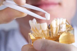Dentist holding a model of a mouth with a dental implant