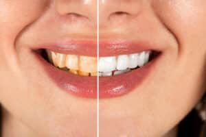 Before-and-after smile showing whiter, brighter teeth after cosmetic dental treatment.