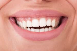 Woman smiling with healthy teeth after gum recontouring