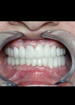 Full Mouth Reconstruction