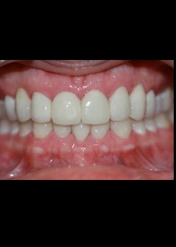 Crowns & Veneers