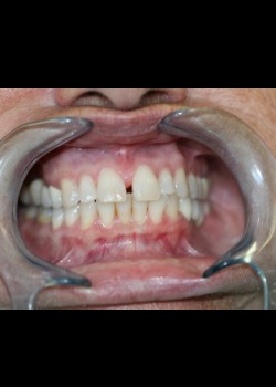 Crowns & Veneers