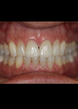 Crowns & Veneers