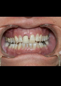 Crowns & Veneers